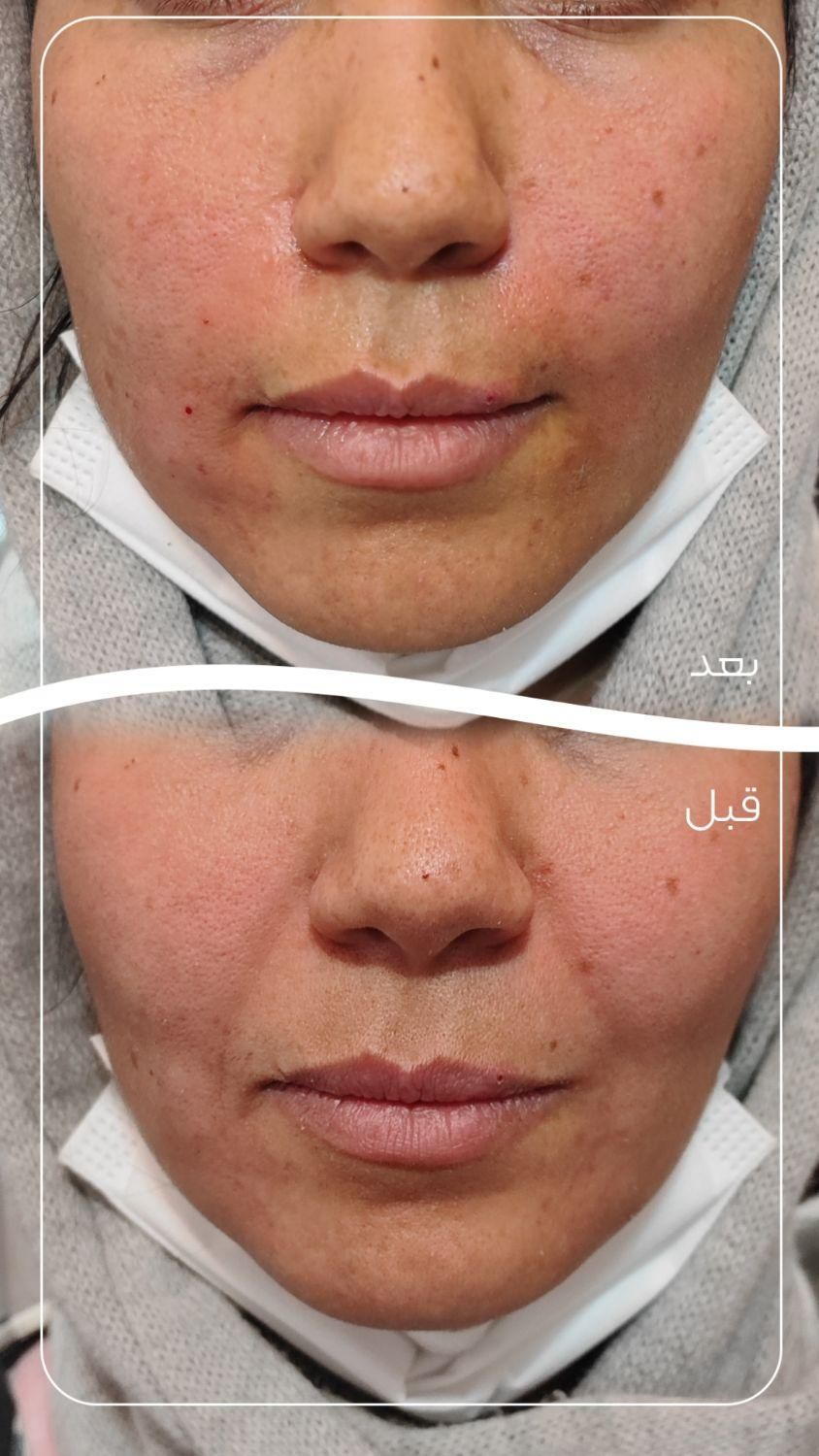 ژل خط خنده ( شوش)|خدمات آرایشگری و زیبایی|شوش, |دیوار