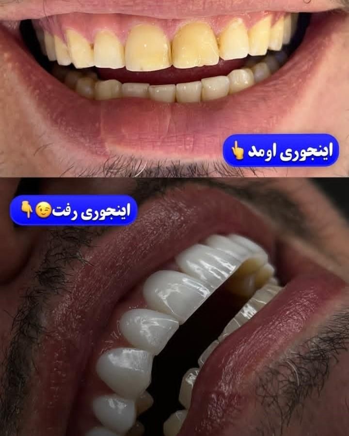 آفرعیدانه‌‌‌طرح‌لبخندکامپوزیت‌ولمینت‌دندان|خدمات آرایشگری و زیبایی|تهران, شهید رجایی|دیوار