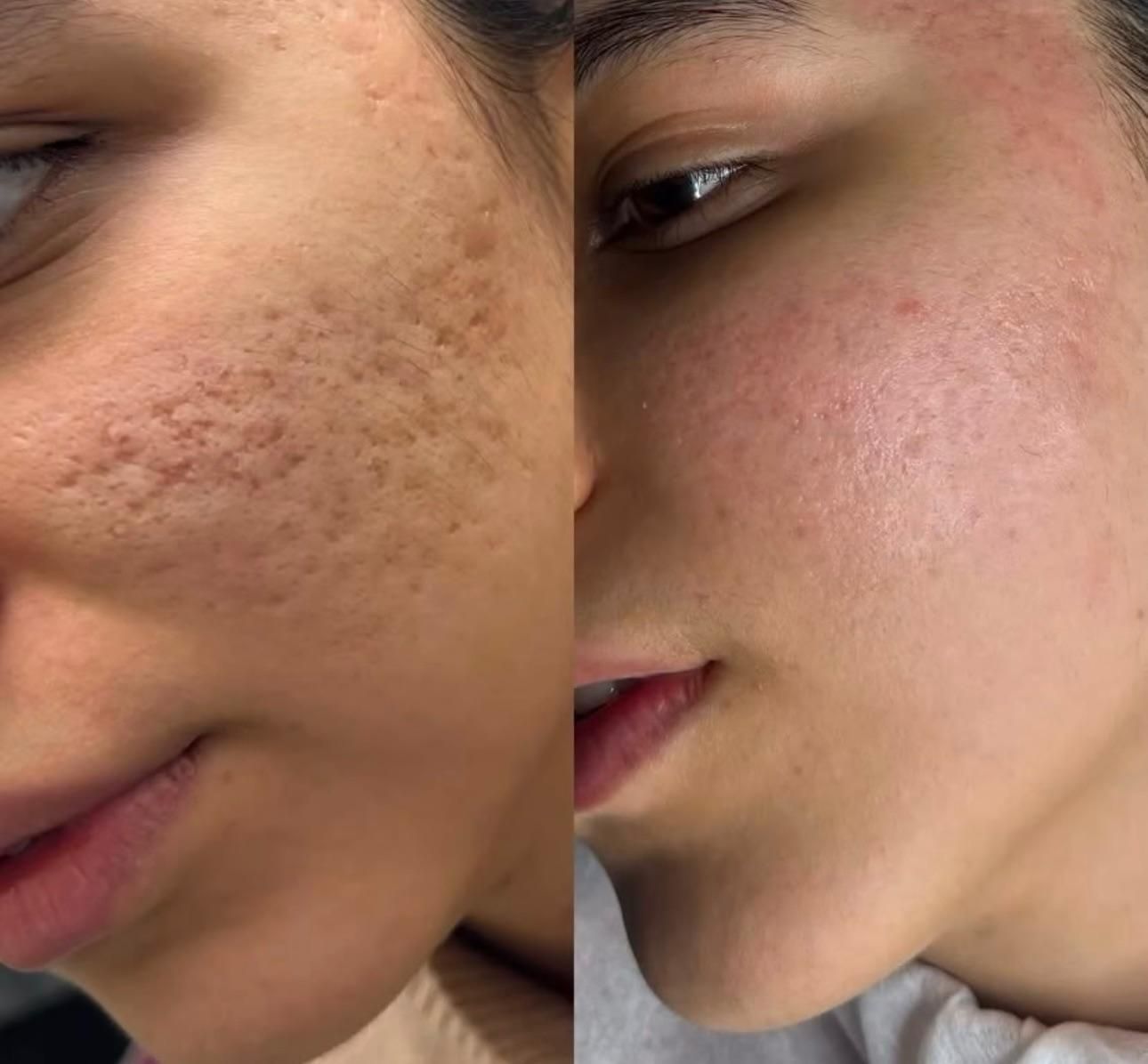 کلینیک پوست/درمان لک/جوش جای جوش/مزونیدلینگ/فشیال|خدمات آرایشگری و زیبایی|مشهد, فرهنگ|دیوار