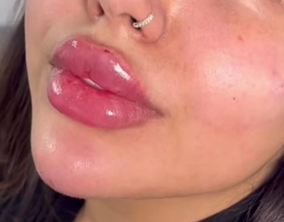 ژل و بوتاکس و مزو سر و صورت|خدمات آرایشگری و زیبایی|کوهدشت, |دیوار