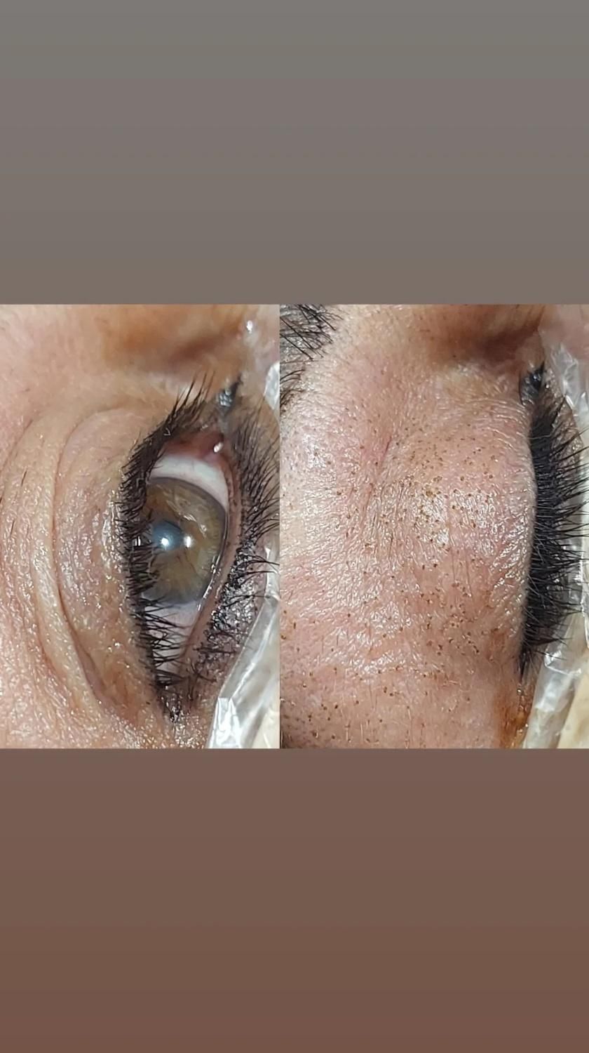 پلکسر مزو میکرونیلدینگ  رفع خال جوانسازی فیشیال|خدمات آرایشگری و زیبایی|مشهد, طلاب|دیوار