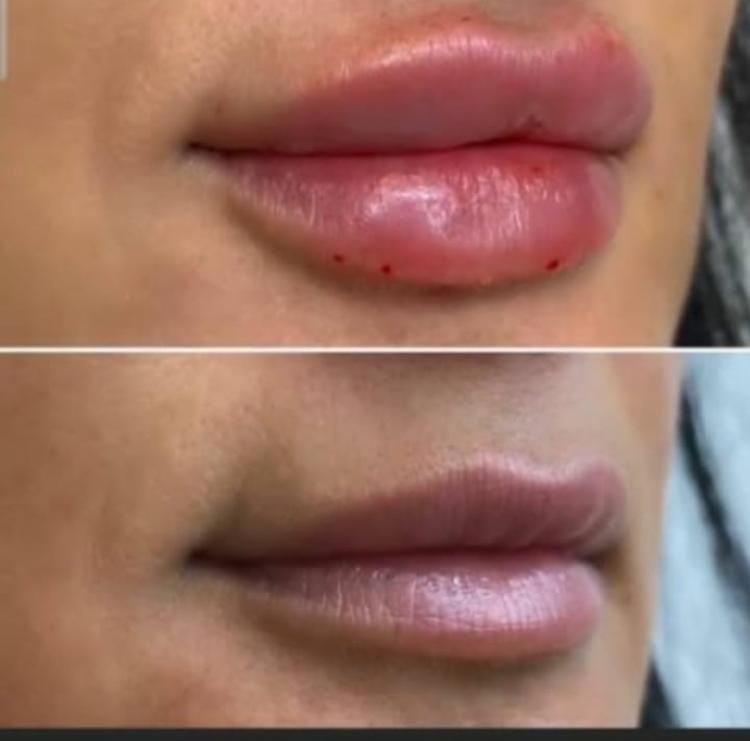 جشنواره نوروزمدل ژل وبوتاکس هایفو تراپی مزوتراپی ‌|خدمات آرایشگری و زیبایی|تهران, تهرانپارس شرقی|دیوار