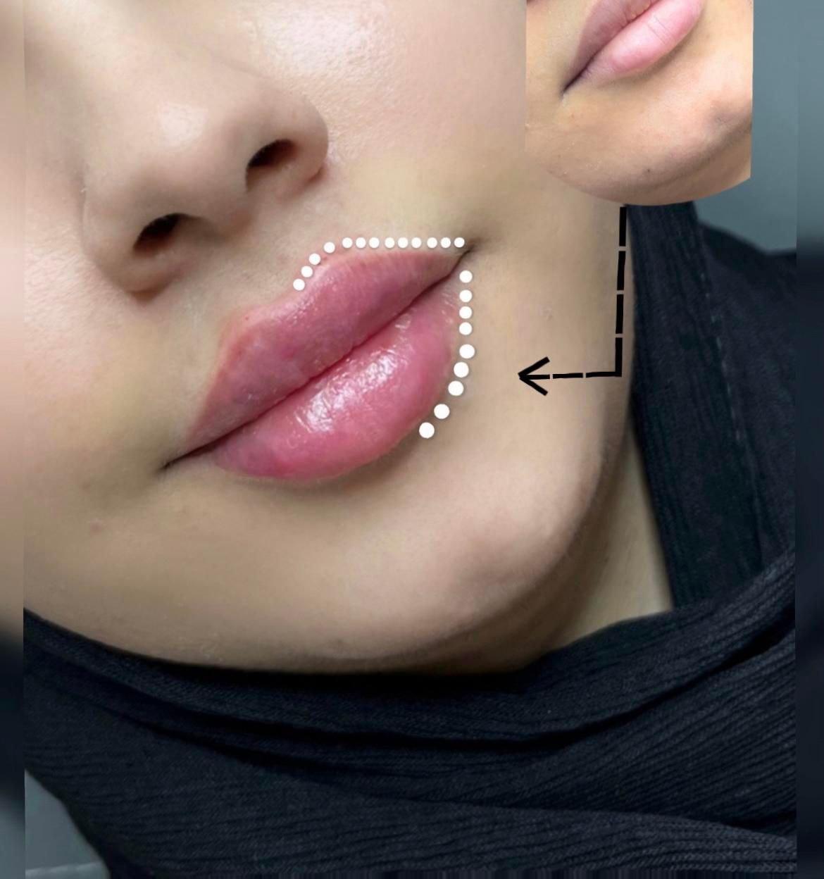 مطب تخفیف ژل و فیلر لب و صورت و بوتاکس|خدمات آرایشگری و زیبایی|قم, صفائیه|دیوار