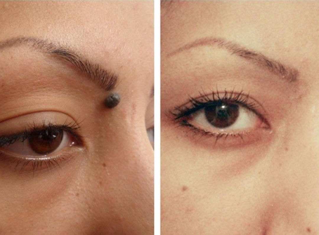 برداشتن زگیل ،خال ،میخچه،و بوتاکس میگرن|خدمات آرایشگری و زیبایی|سنندج, |دیوار