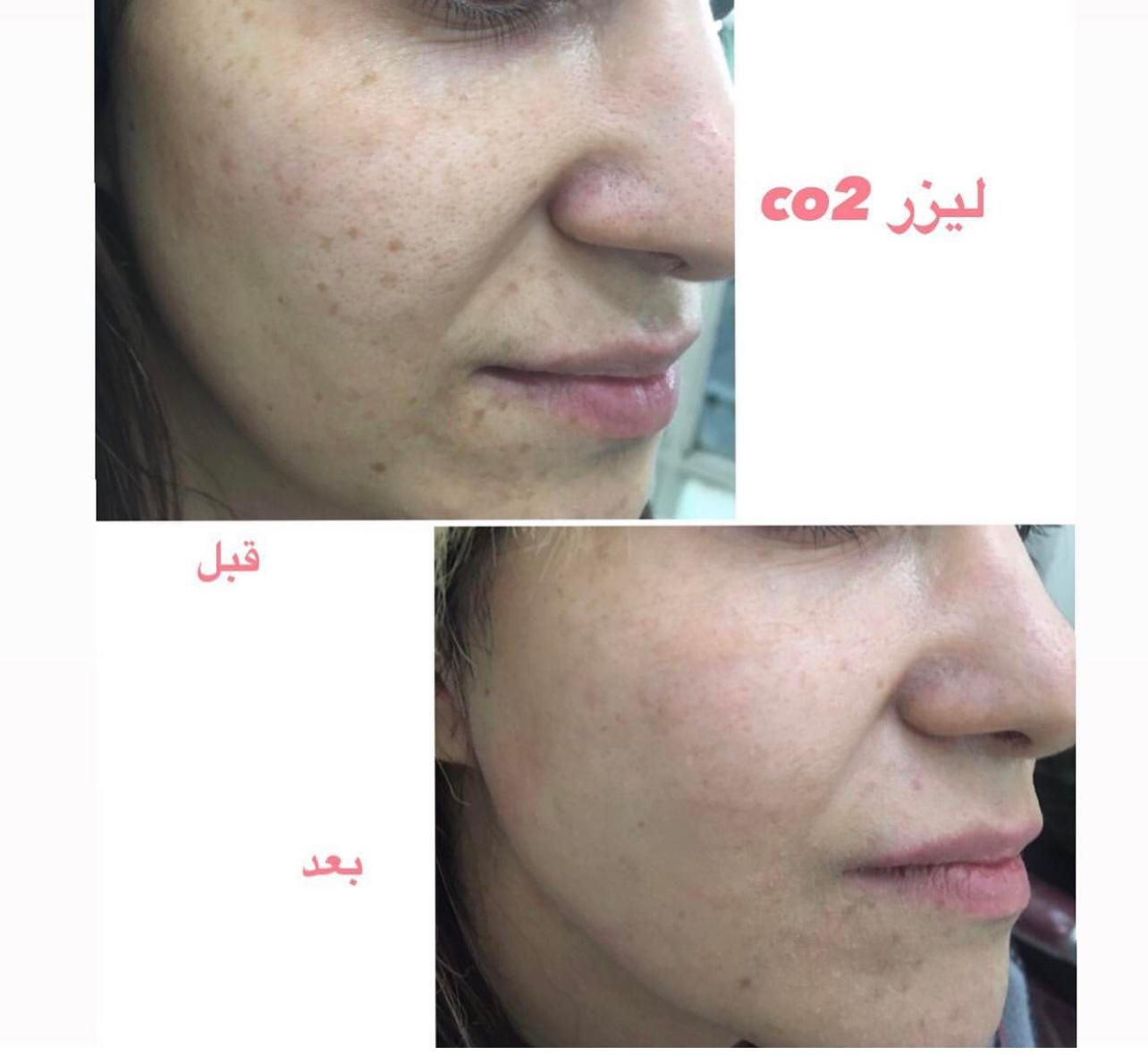 لیزر co2 فراکشنال و هایفوی پزشکی نه رومیزی|خدمات آرایشگری و زیبایی|اهواز, کیانپارس |دیوار