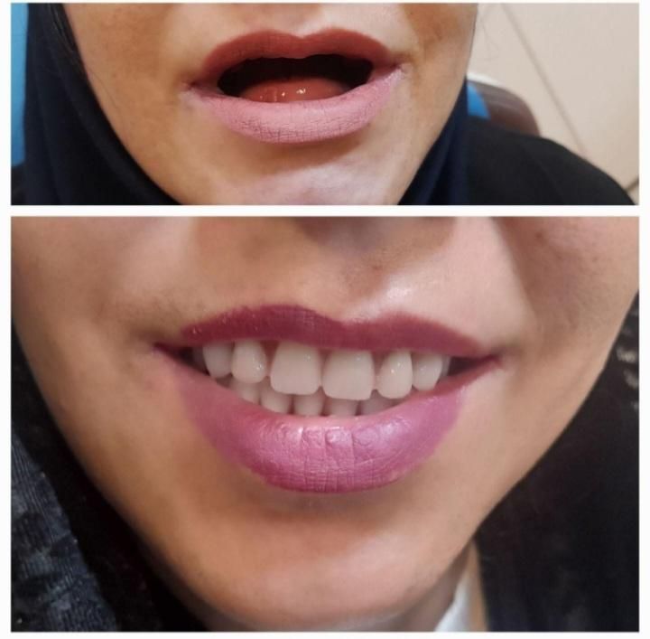 دندانسازی /دندان متحرک /دندان مصنوعی|خدمات آرایشگری و زیبایی|مشهد, حرم مطهر رضوی|دیوار