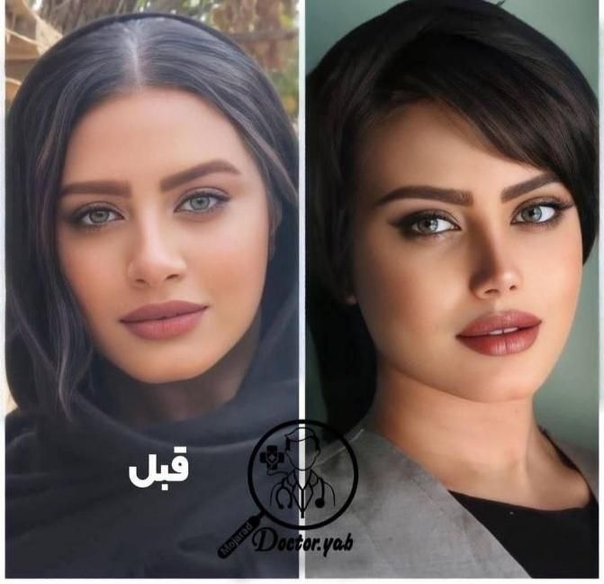 عمل بینی فقط ۲۵م باروشی جدیدبدون درد+مشاوره رایگان|خدمات آرایشگری و زیبایی|شیراز, فرهنگ شهر|دیوار