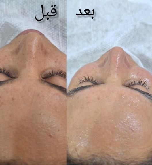 تکنیک مزووایت(روشن کننده پوست) کرمپودر دائم|خدمات آرایشگری و زیبایی|لاهیجان, انقلاب|دیوار
