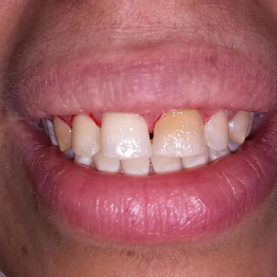 کامپوزیت دندان لمینت ایمپلنت دندانپزشکی عصبکشی|خدمات آرایشگری و زیبایی|شیراز, قصرالدشت|دیوار