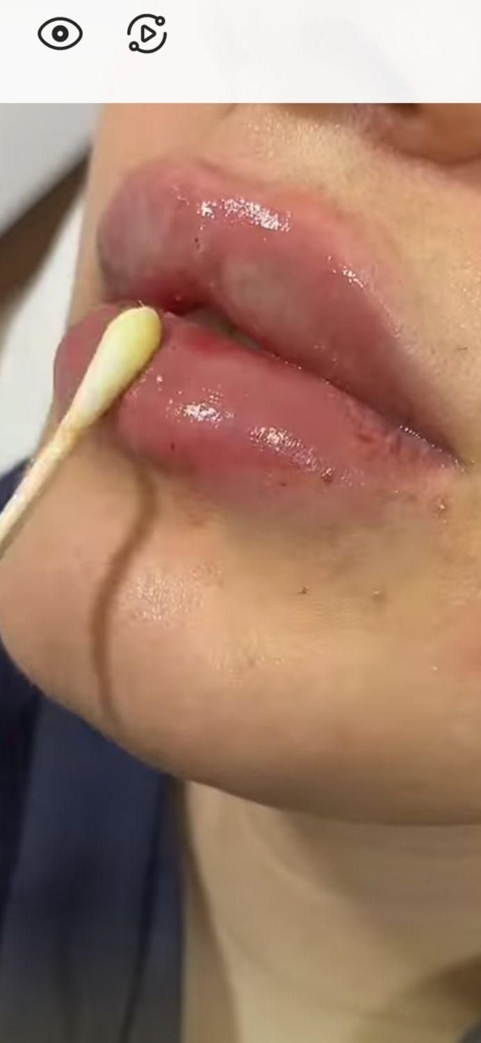 بوتاکس  (تخفیف فوق العاده )هایفوتراپی ژل لیزر|خدمات آرایشگری و زیبایی|مشهد, سرافرازان|دیوار