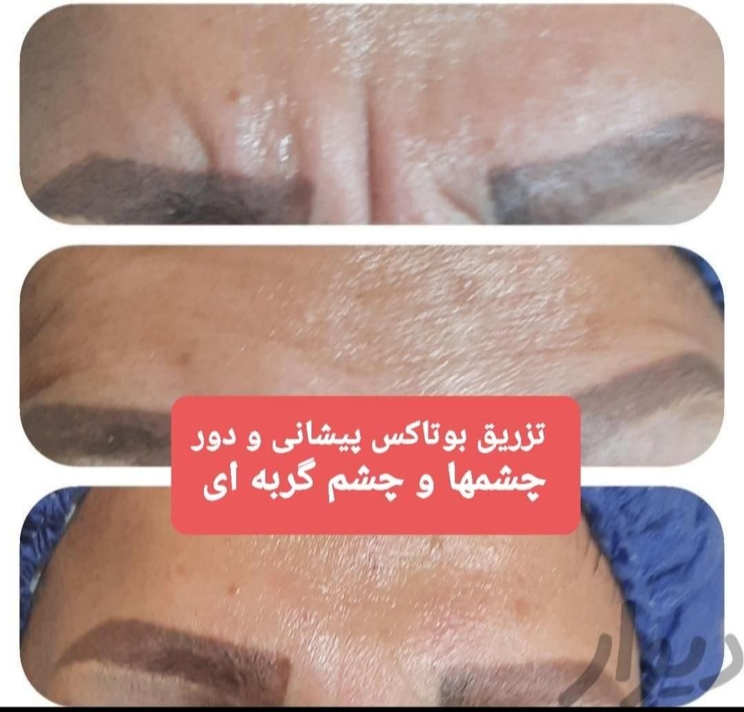 تزریق چربی صورت،ژل،بوتاکس،لیزر،لاغری|خدمات آرایشگری و زیبایی|رشت, گلسار|دیوار