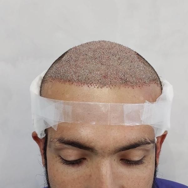 کاشت مو،کاشت ابرو و ریش تخصصی|خدمات آرایشگری و زیبایی|شیراز, قصرالدشت|دیوار