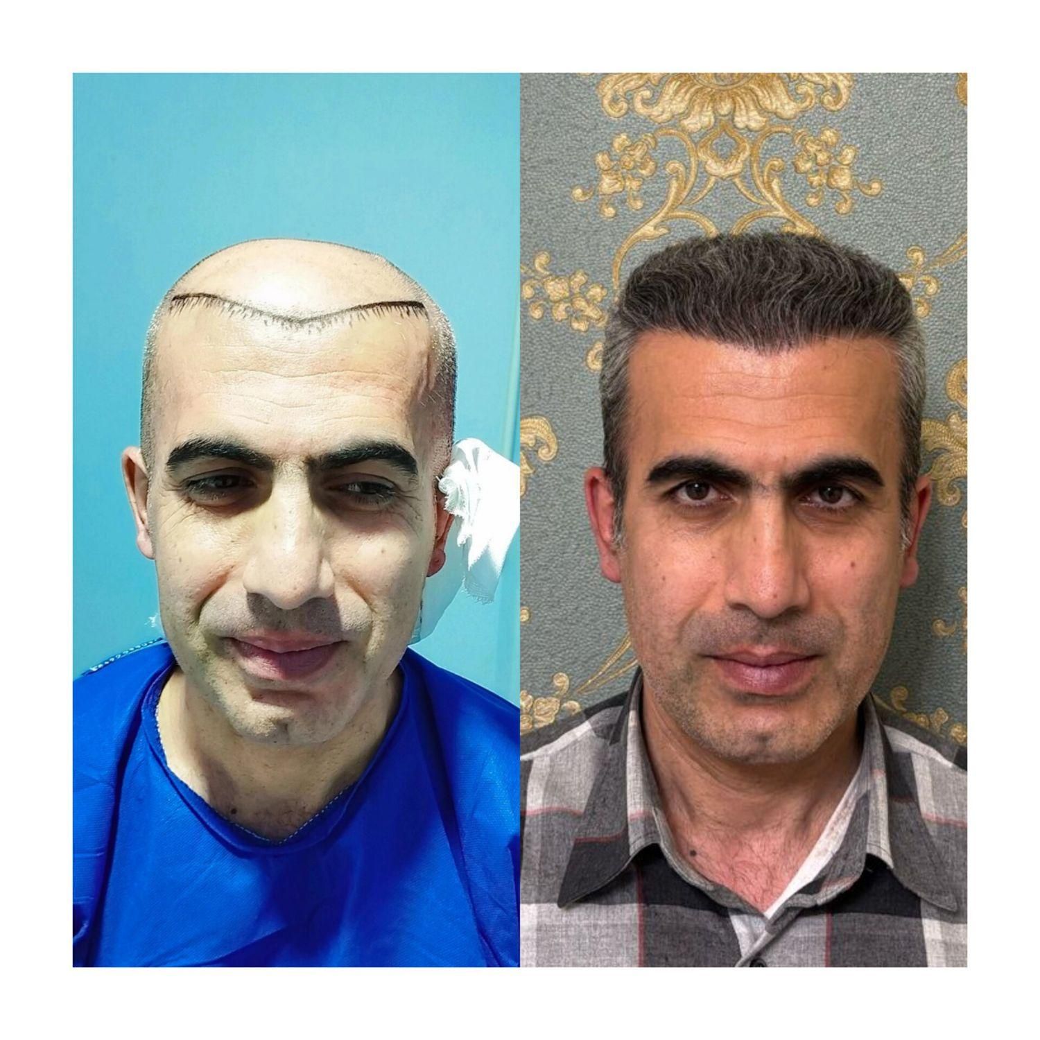 کاشت مو  ابرو  ریش به روش شیرازی|خدمات آرایشگری و زیبایی|سنندج, |دیوار
