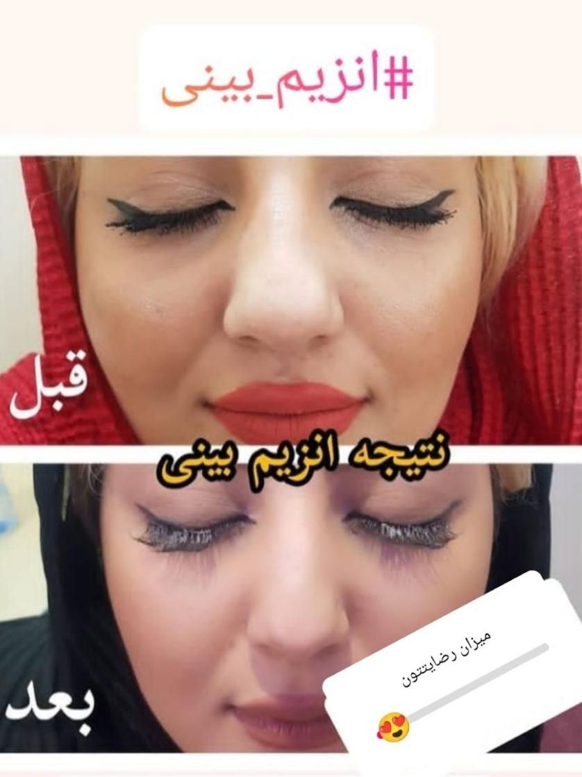 آنزیم ژل لب.بینی.غعبغب. ژل های گلوله شده چربی سوز|خدمات آرایشگری و زیبایی|خرم‌آباد, |دیوار