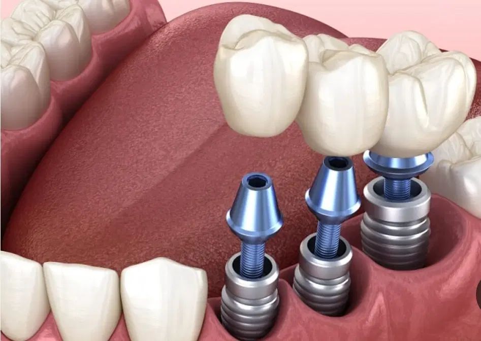 ایمپلنت با قیمت باور نکردنی|خدمات آرایشگری و زیبایی|کرمانشاه, |دیوار