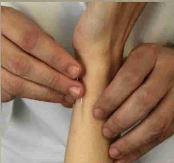آموزش طب سوزنی ، درمان بیماریها با طب سوزنی|خدمات آموزشی|شیراز, قدوسی غربی|دیوار