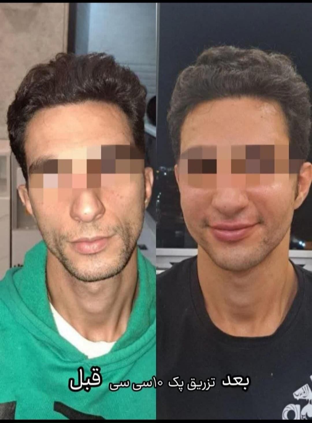 پوست صاف ویکدست میخوای متن آگهی روبخون+پیشنهادویژه|خدمات آرایشگری و زیبایی|قم, باجک دو|دیوار