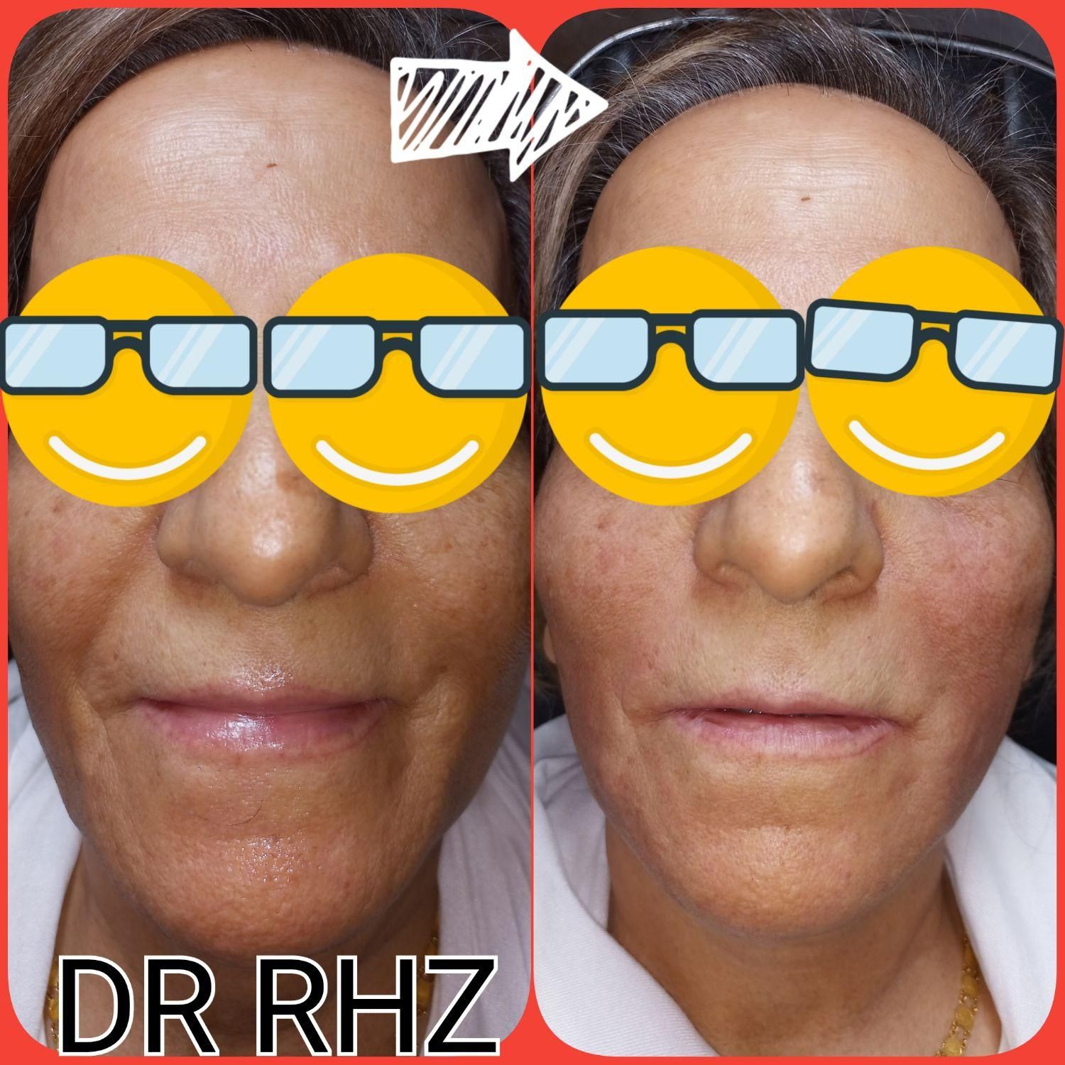 فریز زگیل میخچه/پزشک/بهارستان/خالبرداری|خدمات آرایشگری و زیبایی|اصفهان, بهارستان|دیوار