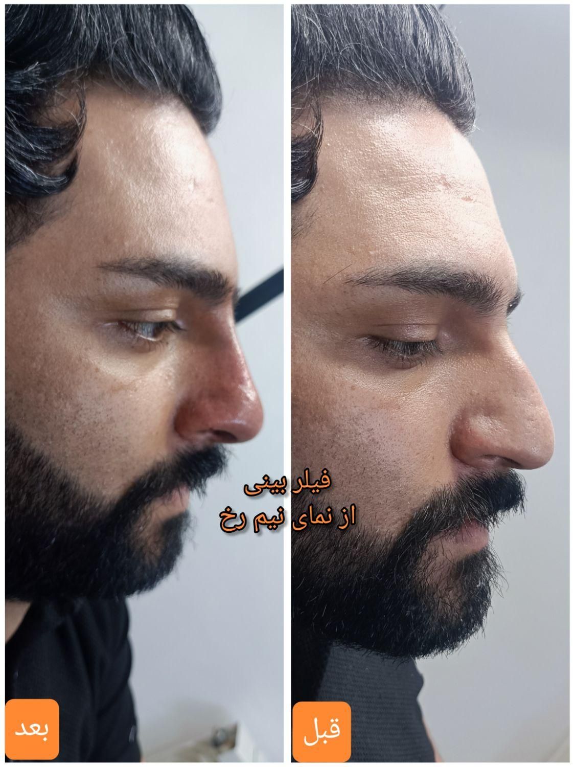 تزریق آنزیم بینی/فیلر بینی/شقیقه/ژل/درکلینیک پزشکی|خدمات آرایشگری و زیبایی|شیراز, زرهی|دیوار