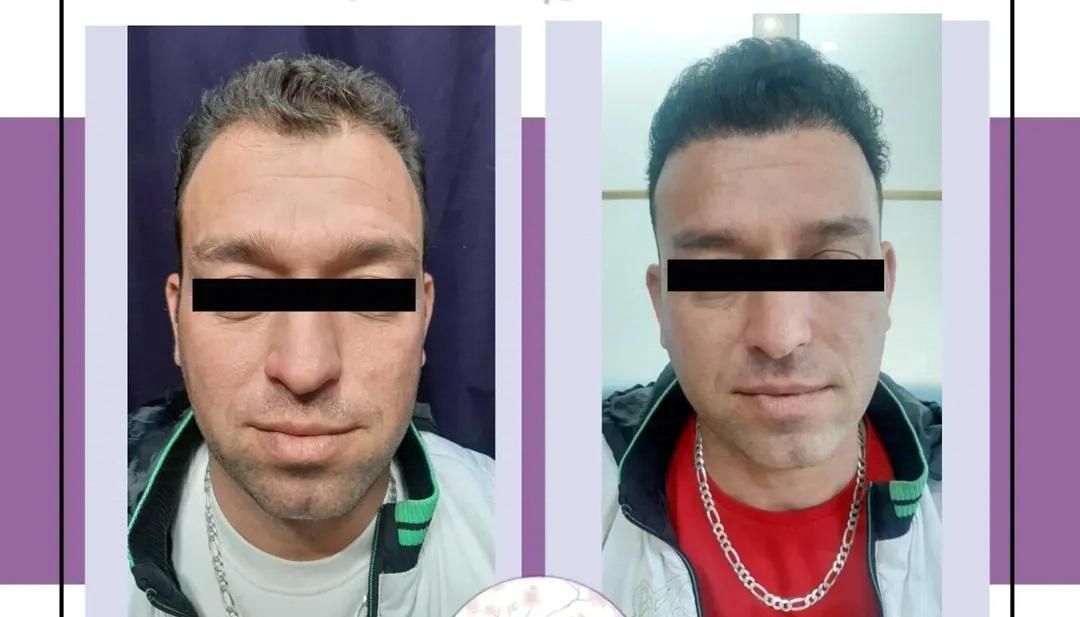 کاشت مو پرتراکم اقساطی با پرداخت 4میلیون تومان|خدمات آرایشگری و زیبایی|اصفهان, میرعماد|دیوار