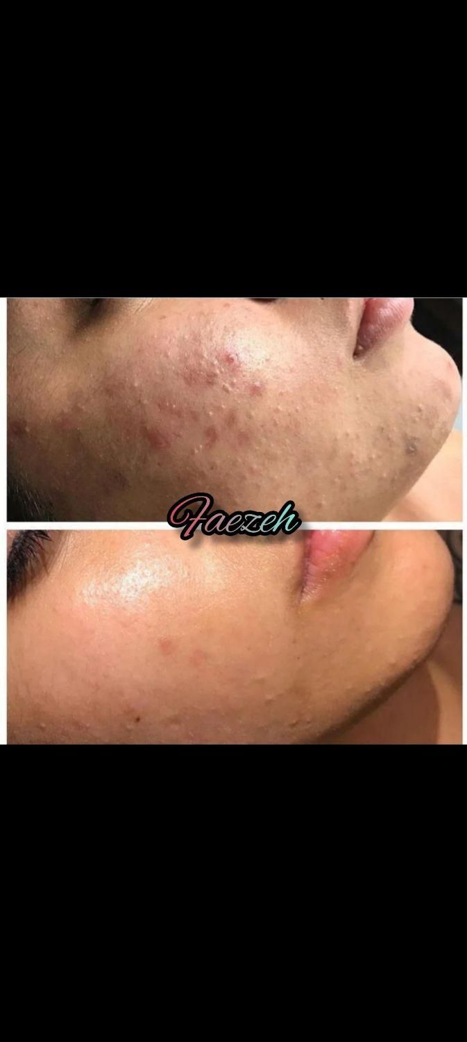 پاکسازی و فیشیال پوست|خدمات آرایشگری و زیبایی|یاسوج, |دیوار
