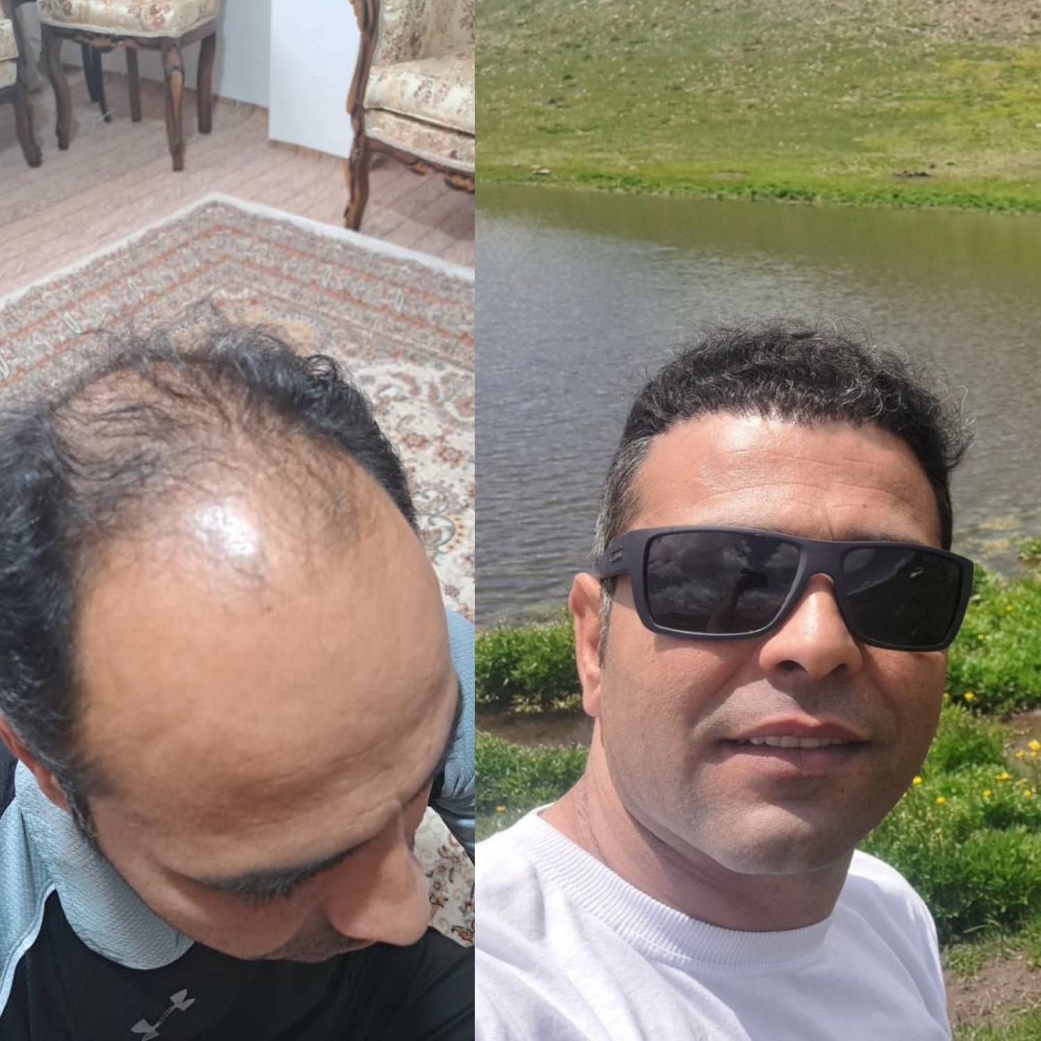 جشنواره کاشت مو|خدمات آرایشگری و زیبایی|زنجان, |دیوار