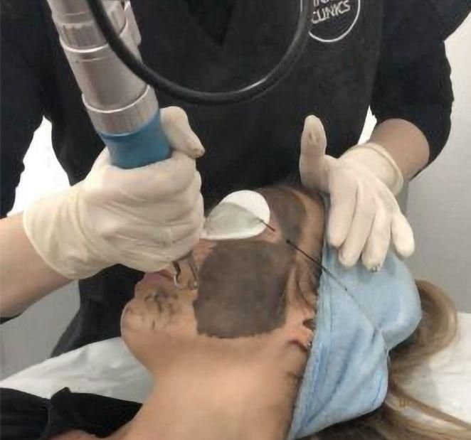 لیزر کیوسوئیچ رفع تیرگی صورت بیکینی و ریمو تاتو|خدمات آرایشگری و زیبایی|ارومیه, |دیوار