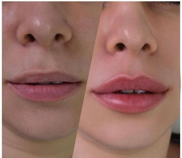 کلینیک پوست و زیبایی ژل لب/فیلرگونه/زاویه/بوتاکس|خدمات آرایشگری و زیبایی|قم, صفائیه|دیوار