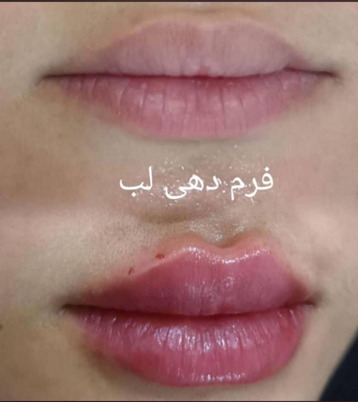 ژل لب گونه،بوتاکس،فیلر بادی صرفا توسط پزشک|خدمات آرایشگری و زیبایی|اهواز, کیانپارس |دیوار