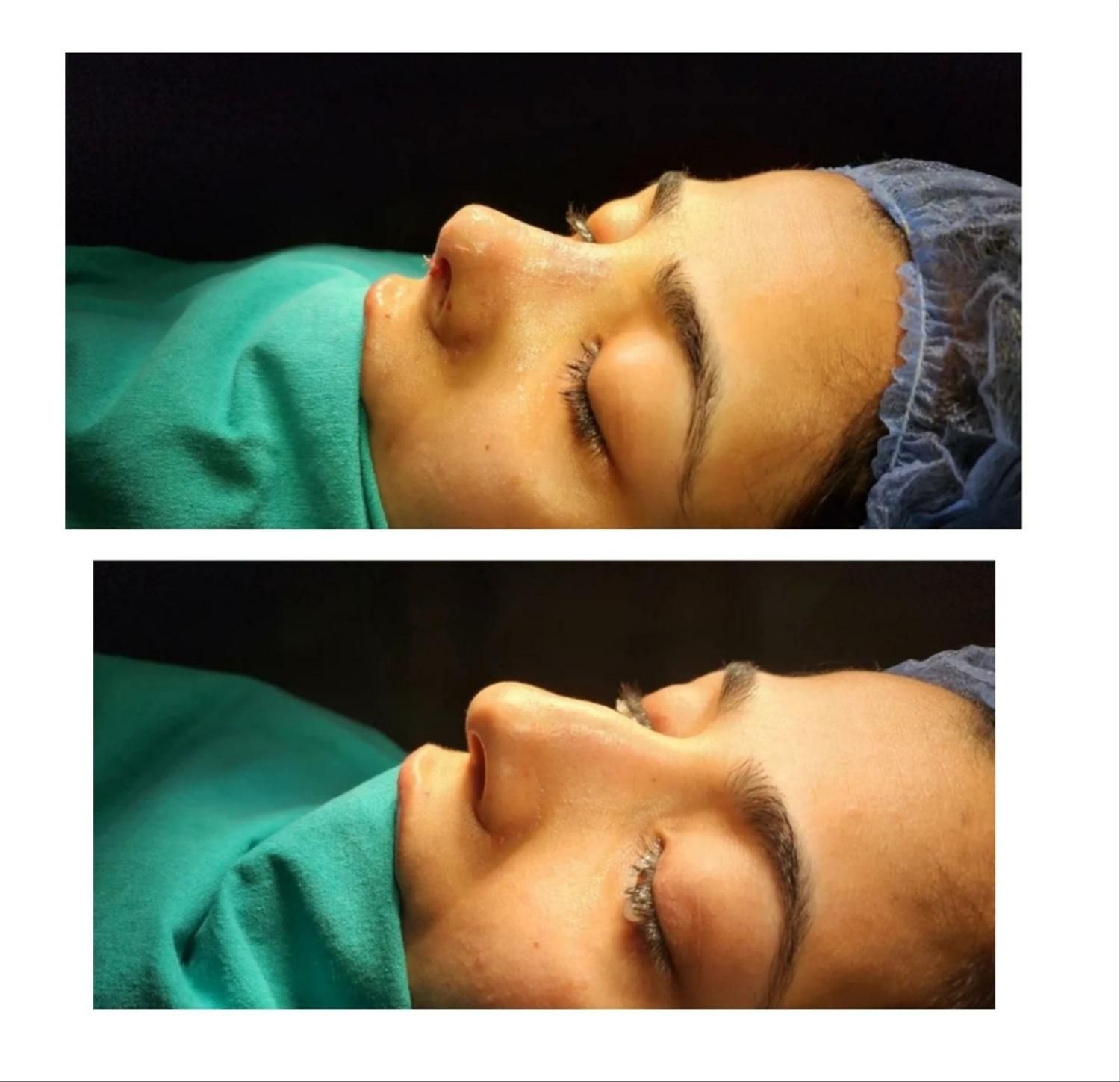 عمل زیبایی بینی، رینوپلاستی (شوش)|خدمات آرایشگری و زیبایی|شوش, |دیوار