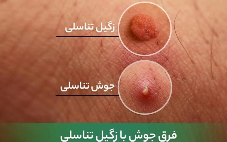 درمان زگیل،تبخال تناسلی خانمهاو آقایان،درمطب متخصص|خدمات آرایشگری و زیبایی|تبریز, |دیوار