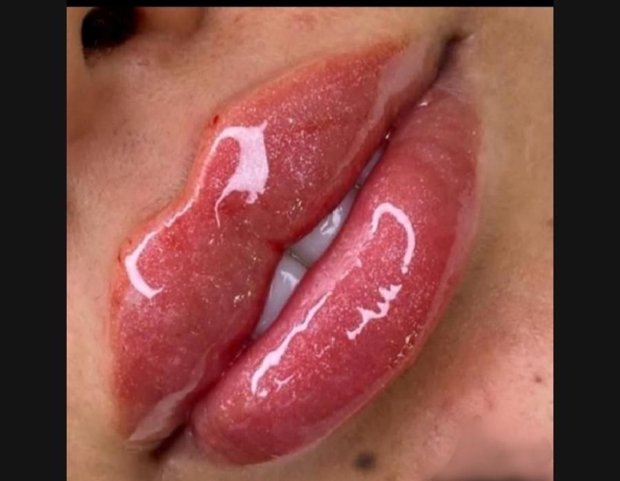 مطب ژل وبوتاکس لب لیفت با نخ رفع گودی چشم جدید|خدمات آرایشگری و زیبایی|گرگان, |دیوار