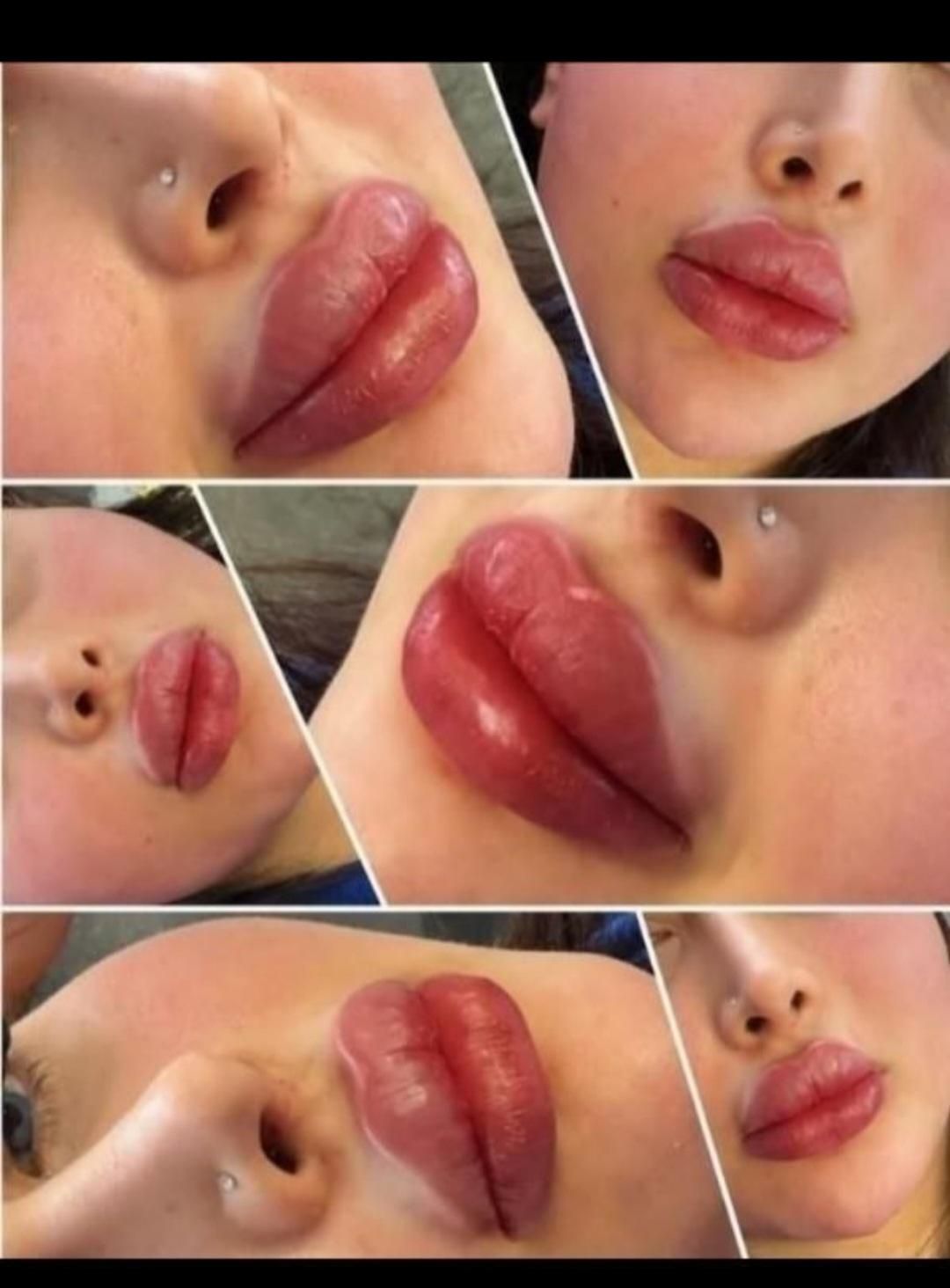 ژل و بوتاکس و مزو سر و صورت|خدمات آرایشگری و زیبایی|کوهدشت, |دیوار