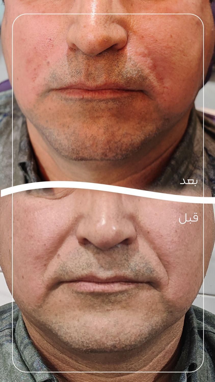 ژل خط خنده ( شوش)|خدمات آرایشگری و زیبایی|شوش, |دیوار