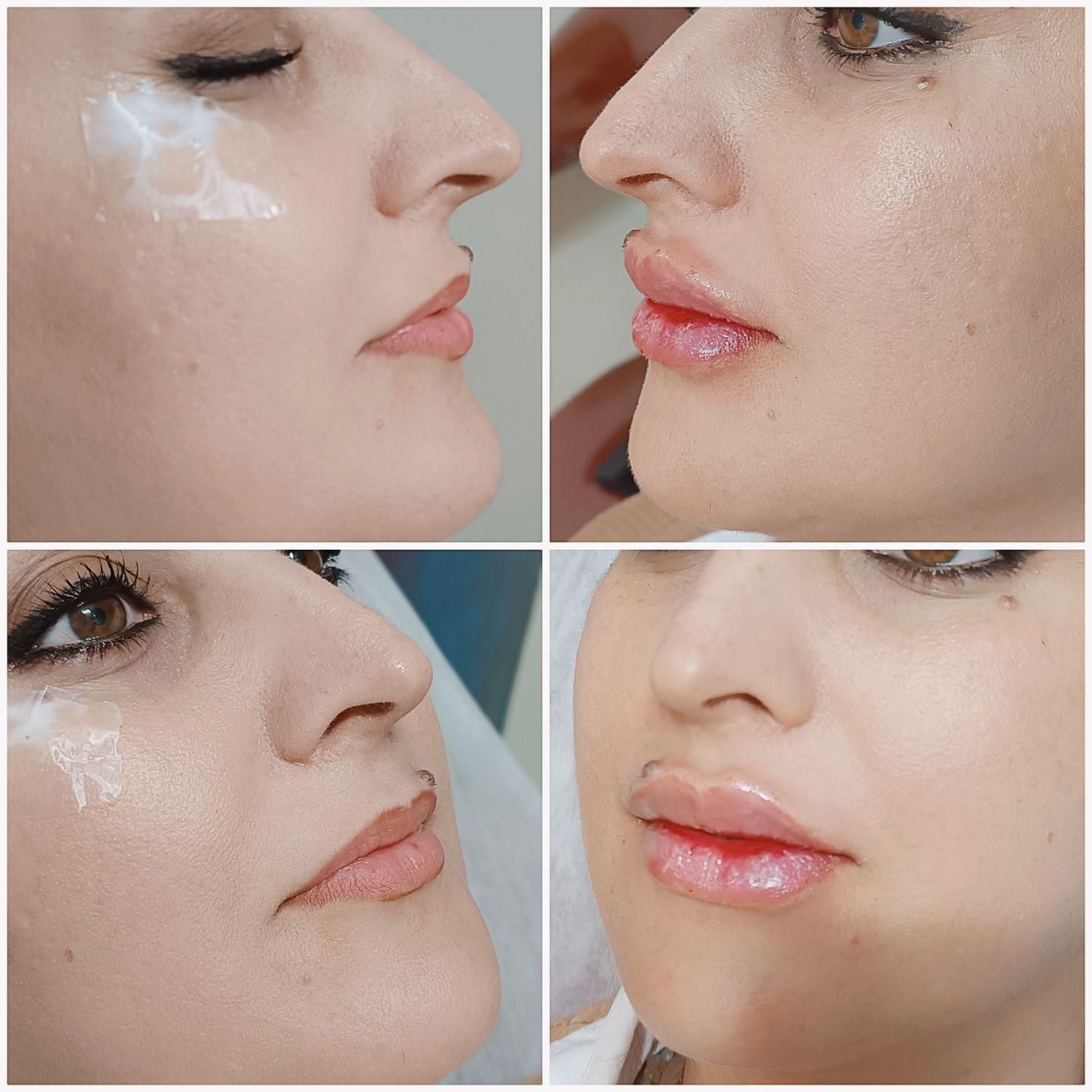 تزریق تخصصی ژل و بوتاکس با متد جدید|خدمات آرایشگری و زیبایی|تهران, نارمک|دیوار