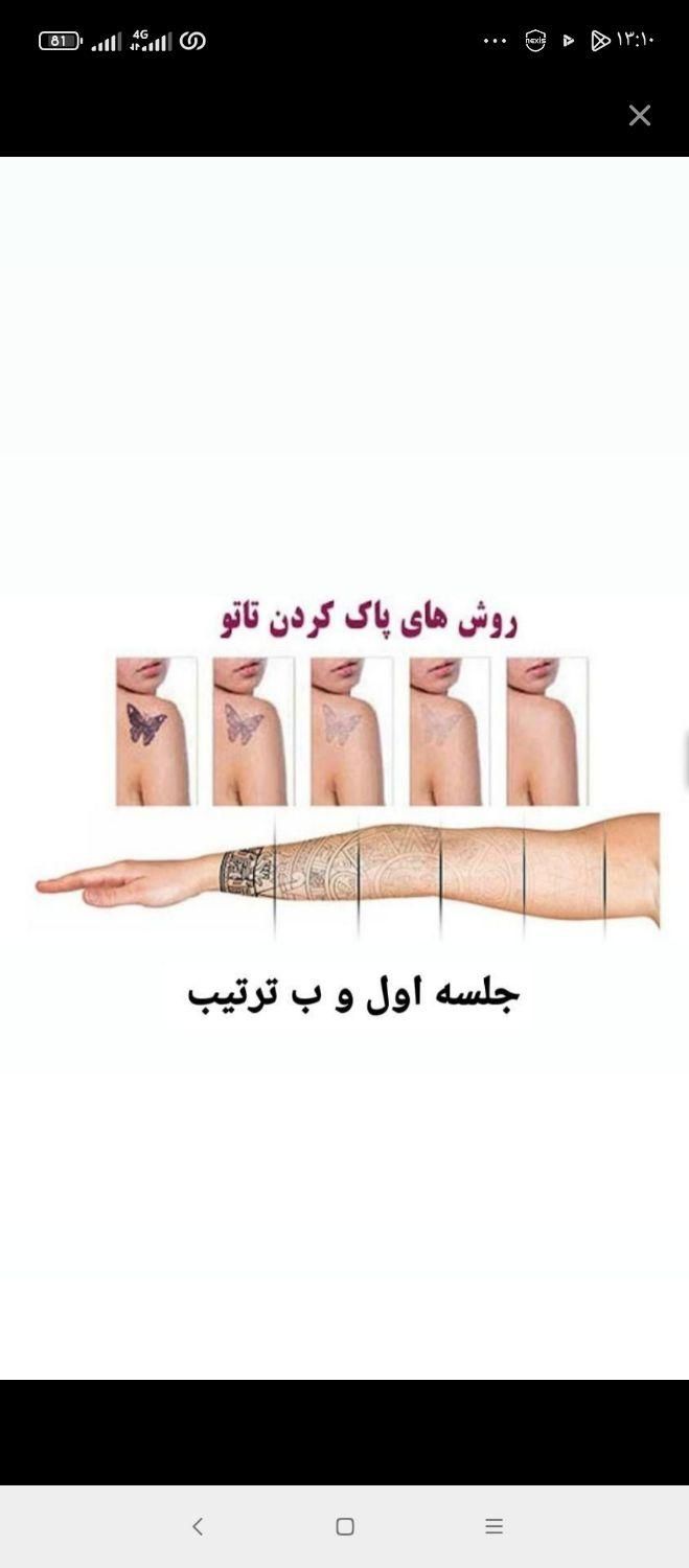 پاک کردن تتو با لیزر (کیوسوییچ)و کربن تراپی|خدمات آرایشگری و زیبایی|مشهد, مهدی آباد|دیوار