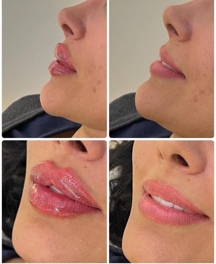 فیلر ژل بوتاکس نخ لیفت و جوانساز زاویه هایفو|خدمات آرایشگری و زیبایی|فردیس, فردیس|دیوار