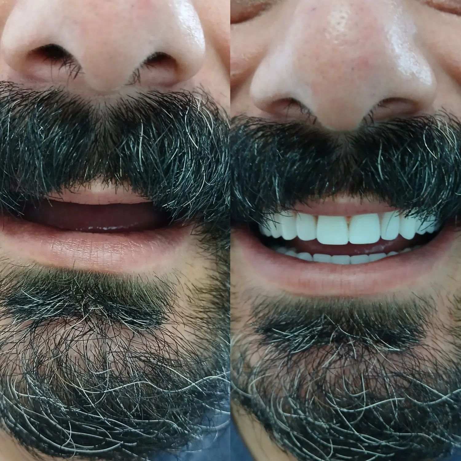 دندانسازی محمدی/طرح کامپوزیت|خدمات آرایشگری و زیبایی|محمدشهر, جعفرآباد|دیوار