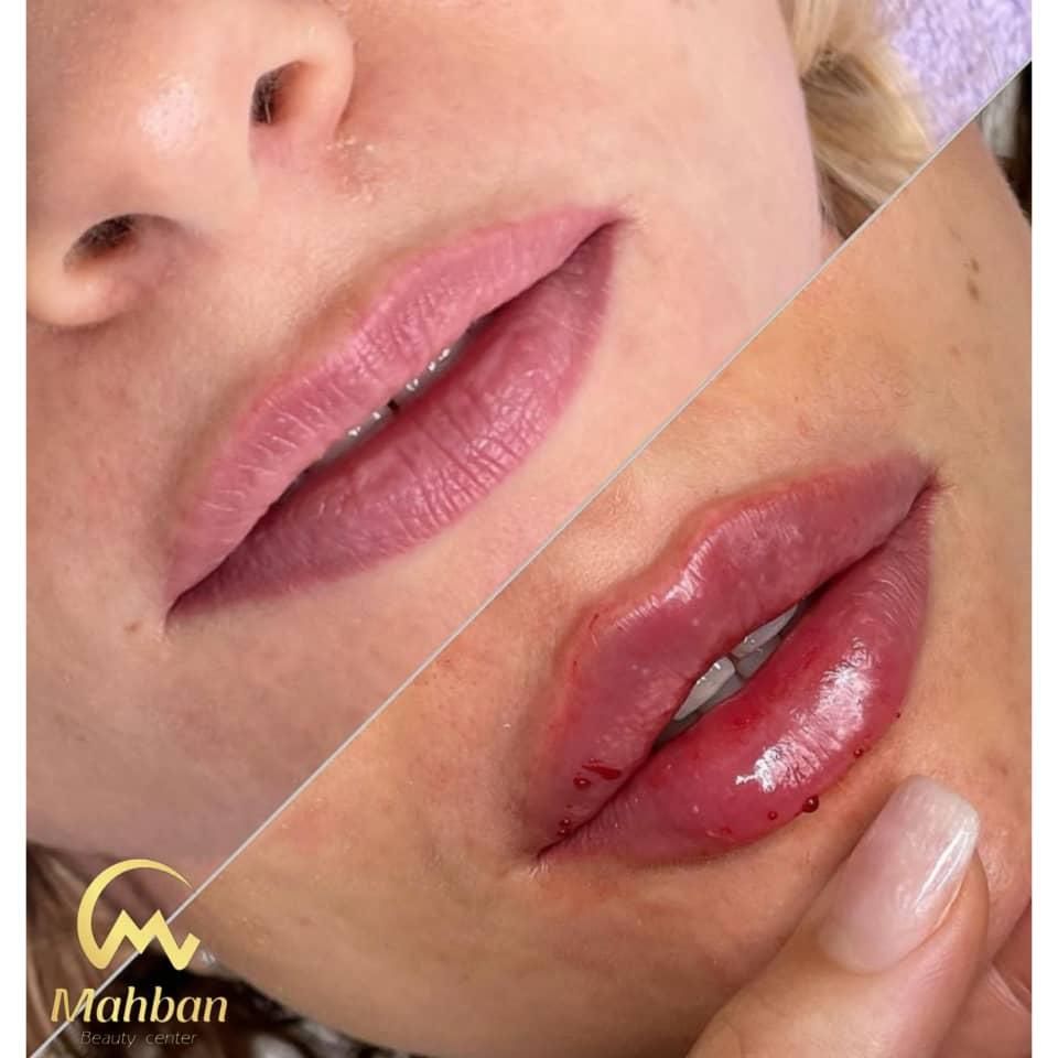 فیلرژل لب بوتاکس فیلر مادلینگ لیزرموهای زائدفشیال|خدمات آرایشگری و زیبایی|تهران, پیروزی|دیوار