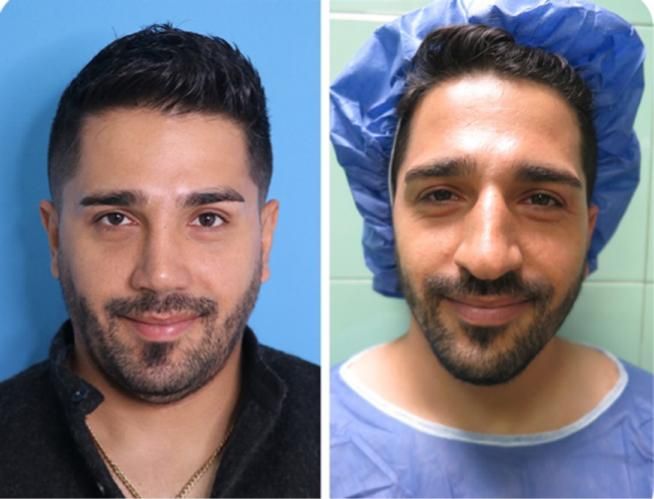 10 میلیون تخفیف عمل جراحی بینی بدون تامپون،لیفت|خدمات آرایشگری و زیبایی|فردیس, طالقانی|دیوار