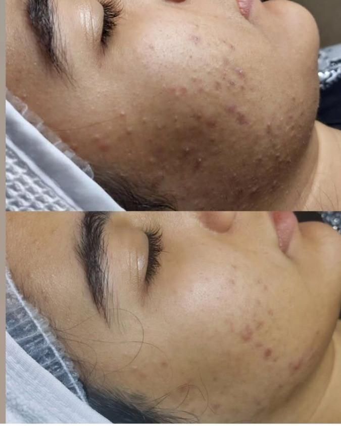 پاکسازی پوست حرفه ای خانم و اقایون در کلینیک|خدمات آرایشگری و زیبایی|اراک, |دیوار