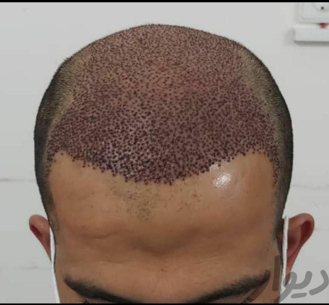 کاشت موی طبیعی به روش fit ،و سوپر sut|خدمات آرایشگری و زیبایی|اهواز, کیانپارس |دیوار
