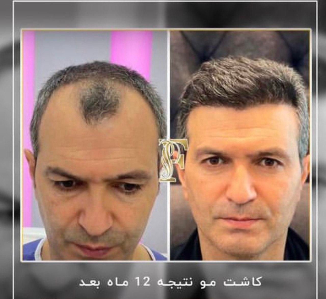 کاشت مو ابرو ریش بدون جراحی با پیشرفته ترین روش|خدمات آرایشگری و زیبایی|تهران, الهیه|دیوار