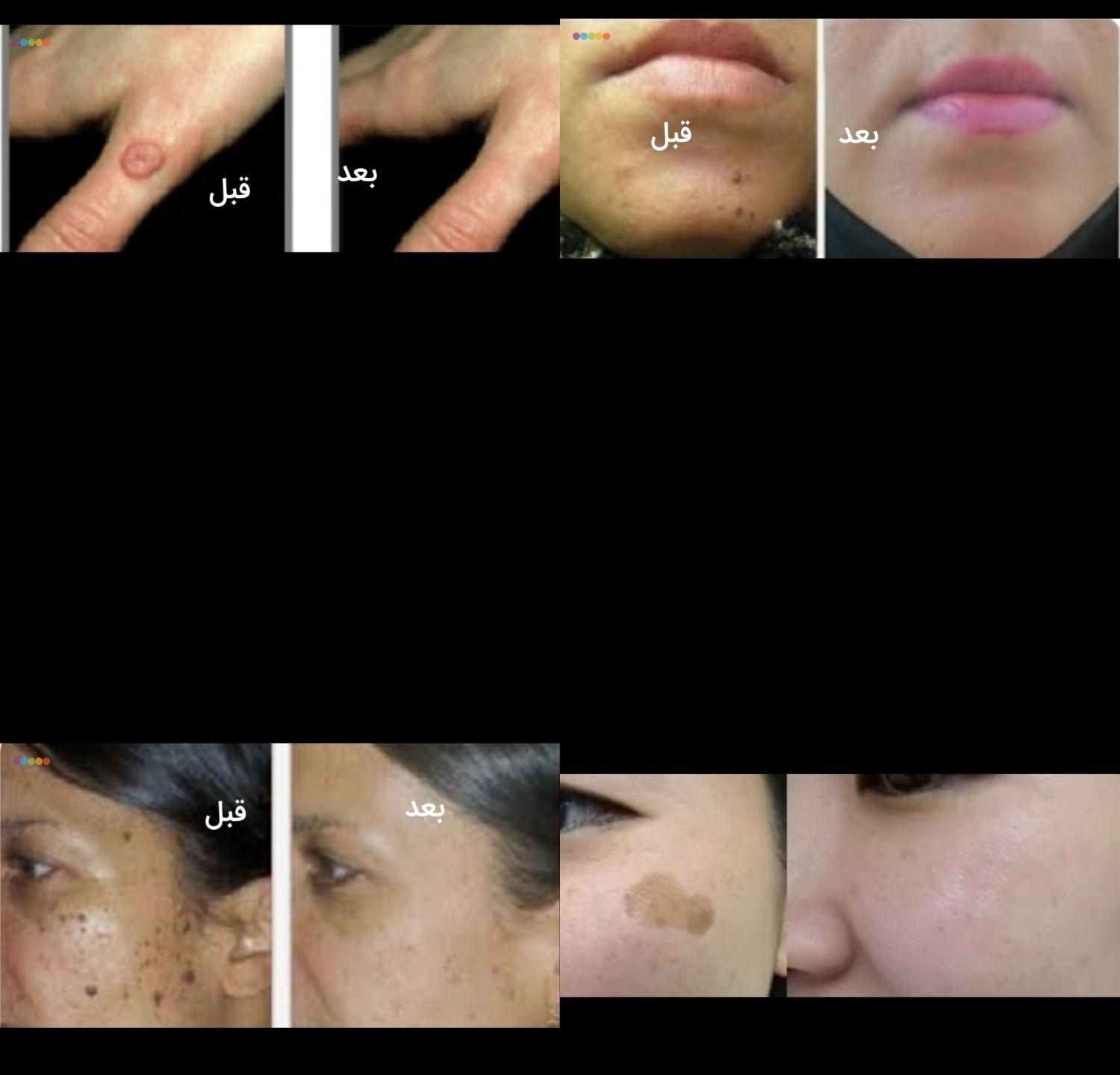 برداشتن انواع خال لک زیگیل تناسلی و...|خدمات آرایشگری و زیبایی|اصفهان, شهرک کوثر|دیوار