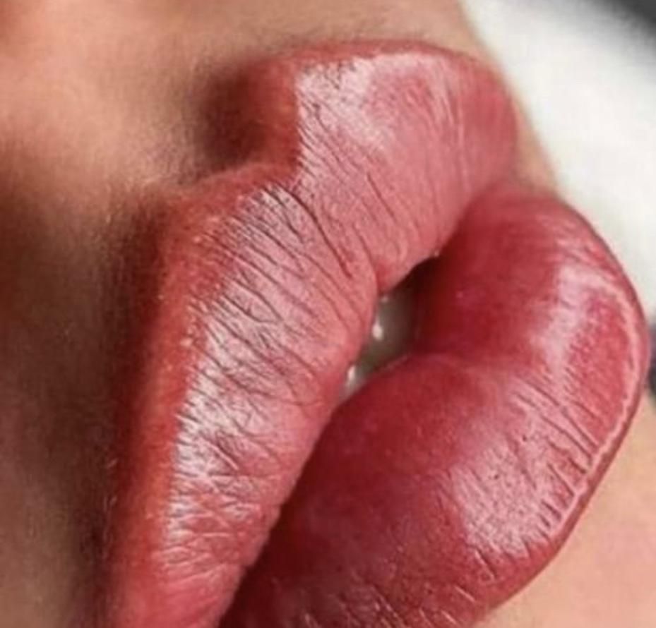 تزریق ژل لب . بوتاکس با ماندگاری بالا لیزر PRP|خدمات آرایشگری و زیبایی|تهران, ستارخان|دیوار