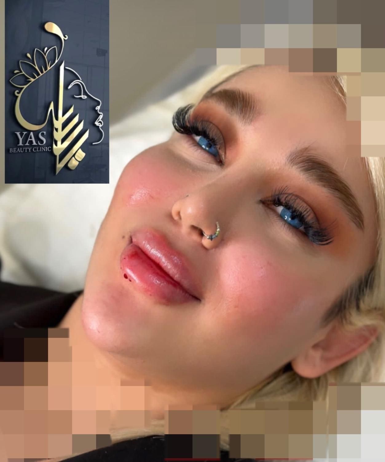 تزریق ژل وبوتاکس ومادلینگ اروپایی وهایفو درکلینیک|خدمات آرایشگری و زیبایی|کرمانشاه, |دیوار