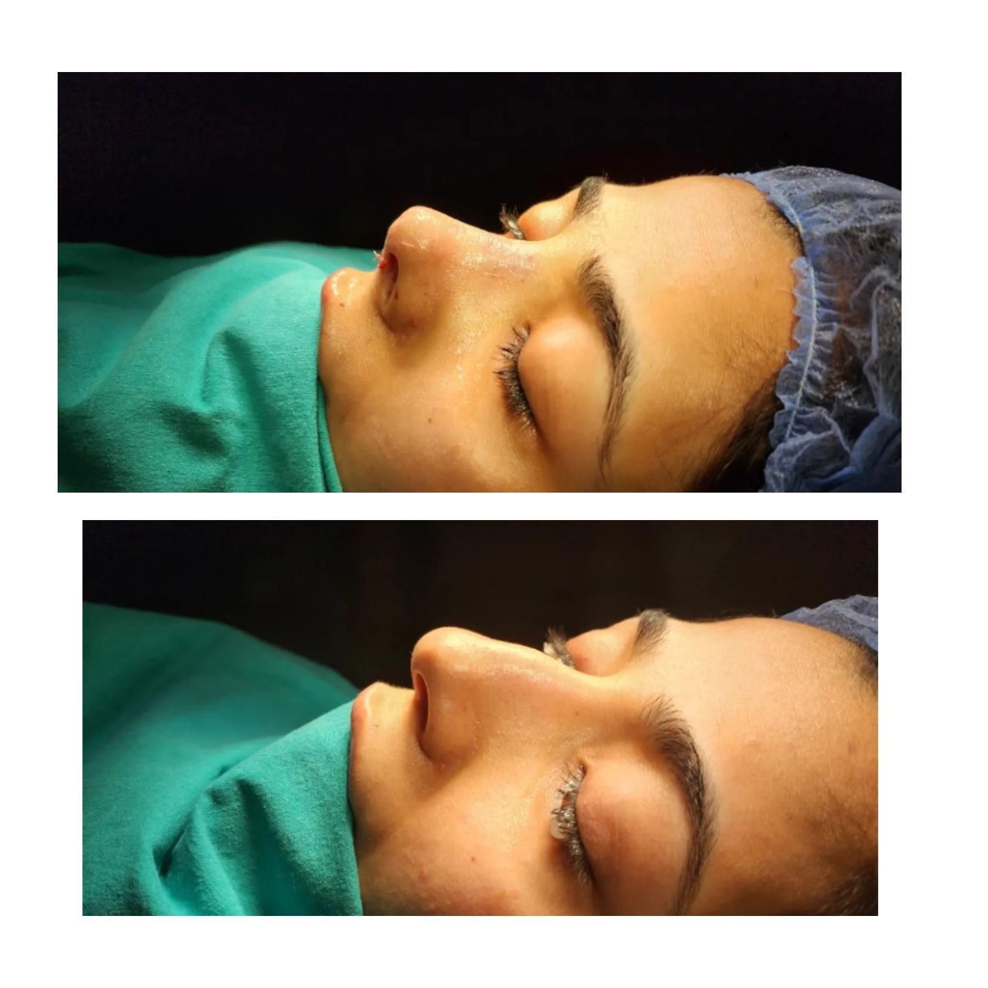 عمل زیبایی بینی(شوش)|خدمات آرایشگری و زیبایی|شوش, |دیوار