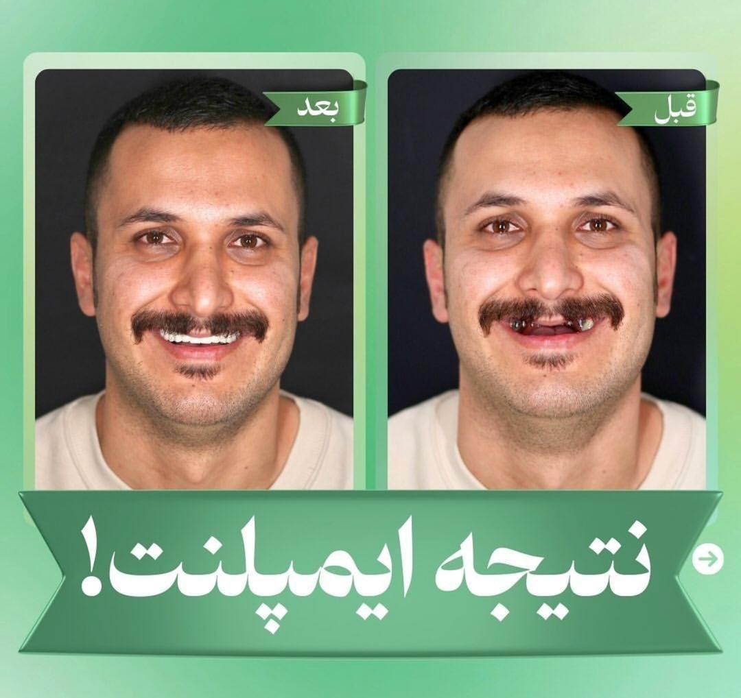 کلینیک تخصصی ایمپلنت دیجیتال5400/فوری/کاشت دندان|خدمات آرایشگری و زیبایی|تهران, پاسداران|دیوار