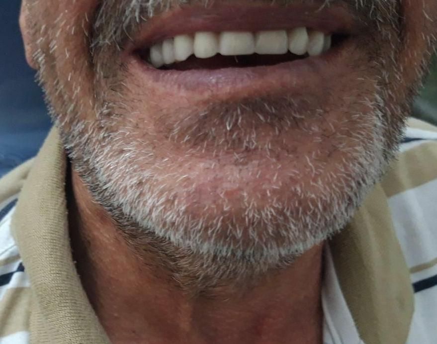 دندان مصنوعی متحرک (تحویل ۳ روزه)|خدمات آرایشگری و زیبایی|کرمانشاه, |دیوار