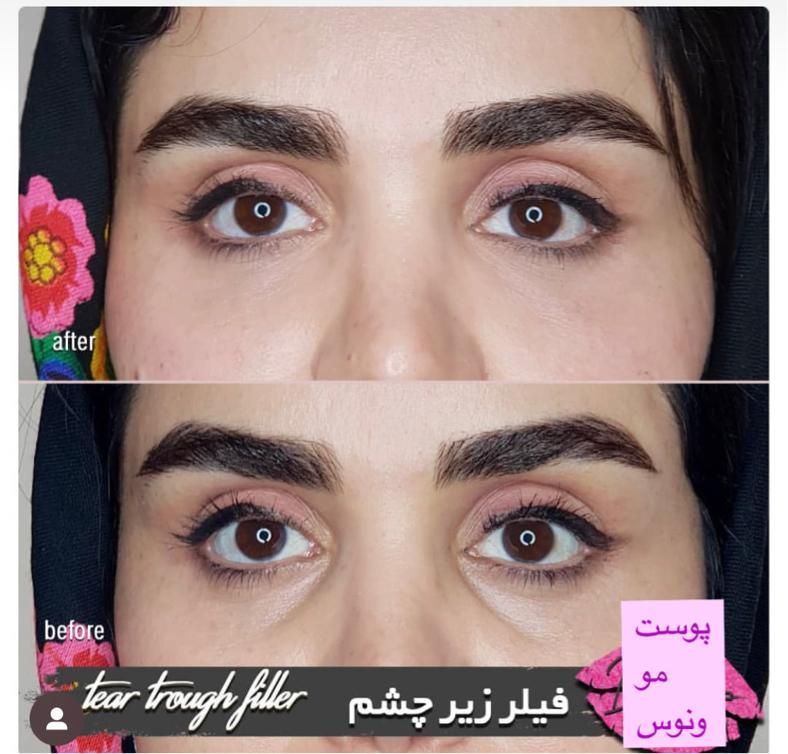 جشنواره50%تزریق ژل390مادلینگ هایفو لیزر مو ‌زائد|خدمات آرایشگری و زیبایی|تهران, ستارخان|دیوار